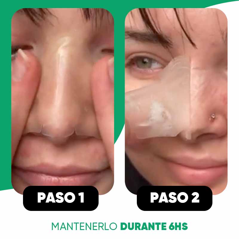 Pack de 10 Parches Anti-Acne para Nariz Luminex