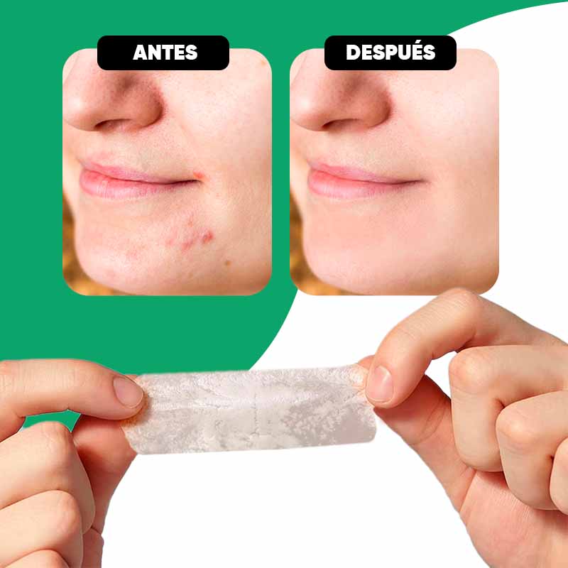 Pack de 10 Parches Anti-Acne Rectangulares Luminex