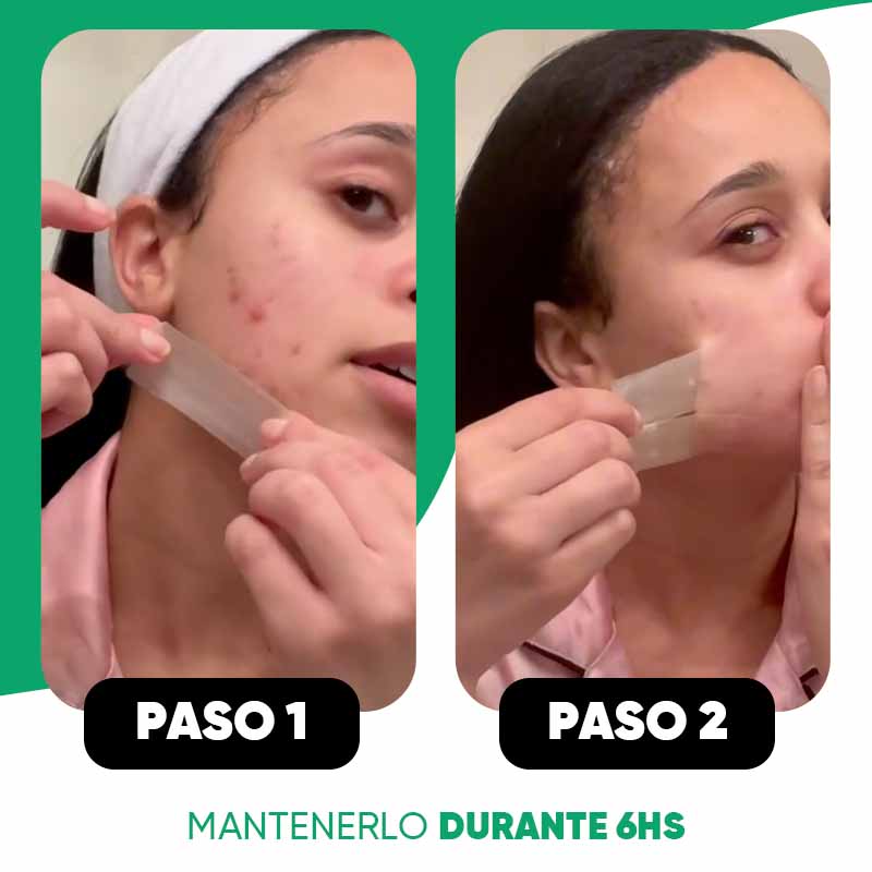 Pack de 10 Parches Anti-Acne Rectangulares Luminex