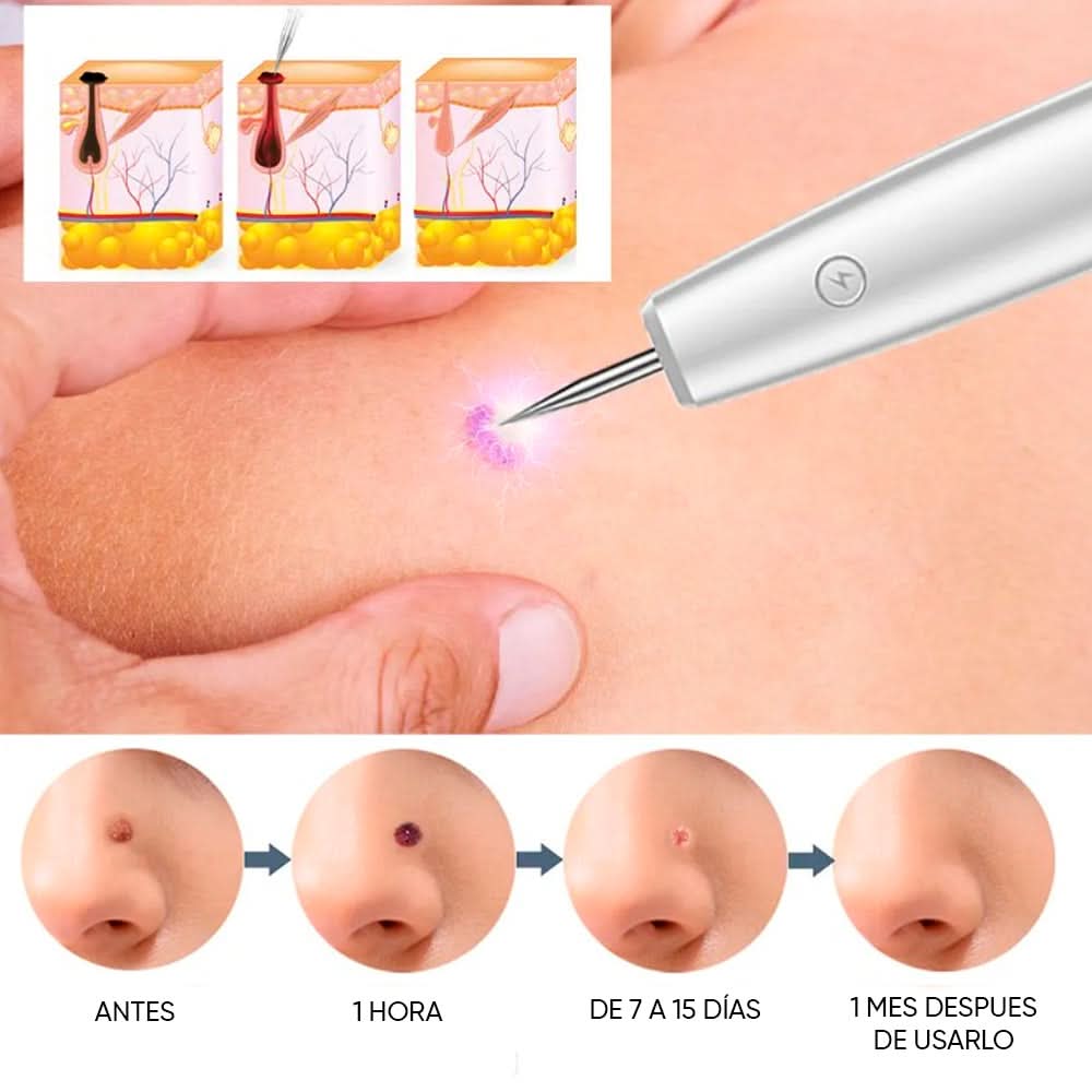 Lapiz Cauterizador de Plasma para Eliminar Manchas