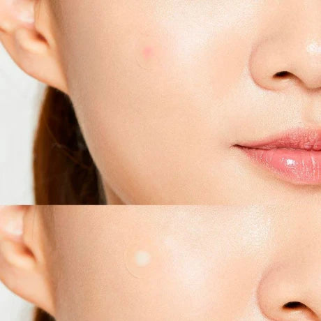 ACNE PIMPLE MASTER - Parches curativos para granos/acné